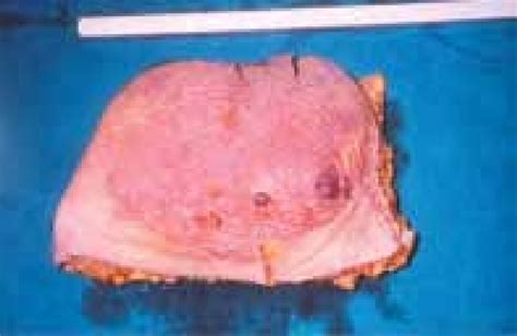 Gross View Of Breast Angiosarcoma Which Developed After Radiotherapy Download Scientific