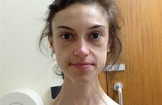 anorexia recovery anorexic weighed just girl 5st remarkable survivor shares lewis emelle who
