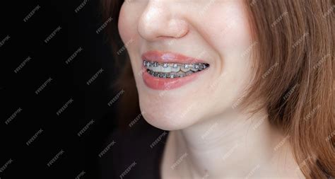 Улыбка молодой и красивой девушки с брекетами на белых зубах выпрямление кривых зубов Премиум Фото
