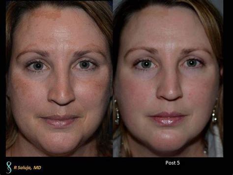 Melasma Treatment Before After Charlotte Huntersville NC Saluja Cosmetic And Laser Center