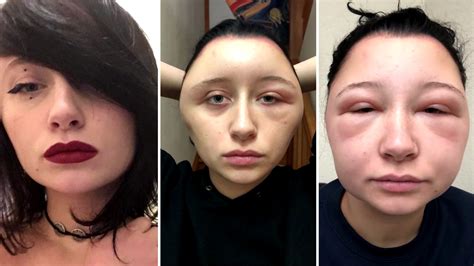 This Womans Head Doubled In Size Due To A Crazy Allergic Reaction To