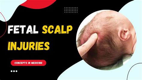 Fetal Scalp Injuries Made Easy Youtube