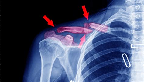 What Is The Average Settlement For A Broken Collarbone Laborde