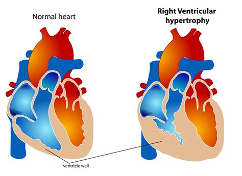 Cardiomegaly Explained By A Cardiologist • Myheart