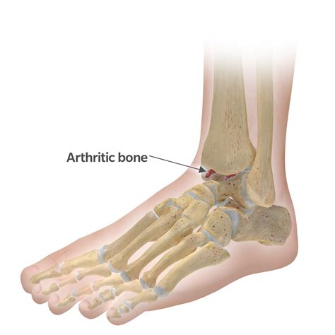 Total Ankle Replacement 7 Common Questions About Recovery Time