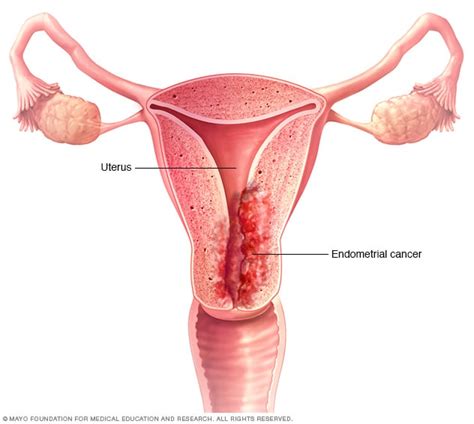 Overview Endometrial Cancer Mayo Clinic