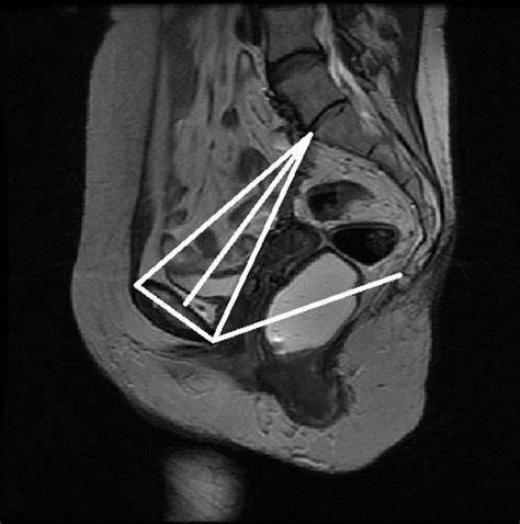 image based measurements for evaluation of pelvic organ prolapse
