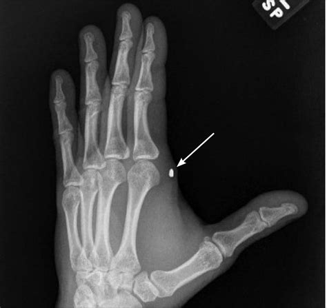 Commonly Missed Radiographic Findings 2016 02 05 Relias Media