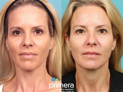 Sculptra Before And After Pictures Case 906 Orlando Florida