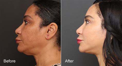 Neck Lift Before And After Photos Nicole Schrader Md Facs