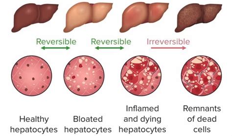 Alcoholic Liver Disease Concise Medical Knowledge