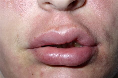 Lip Biting Meaning Causes Symptoms Images Bumps