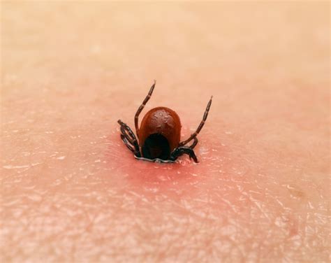 Tick Bite Tale From The Er Doctor Theres A Seed Attached To Me University Health News