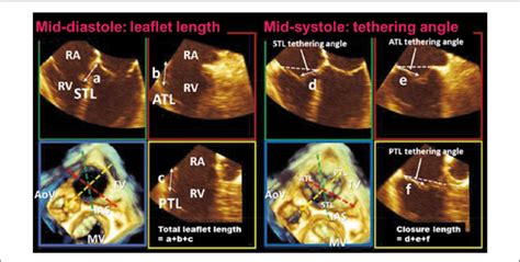 Assessment Of Tricuspid Leaflet Using 3 D Transesophageal Download