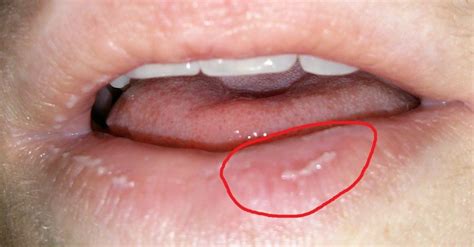 Permanent Peelingdry Spot On Lip At Peeling Lips Exfoliative Cheilitis