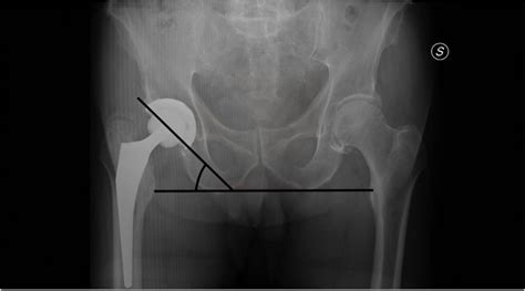 Acetabular Cup Inclination Method Of Calculation Of Acetabular Cup