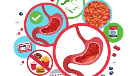 Acute Vs Chronic Gastritis Know The Differences