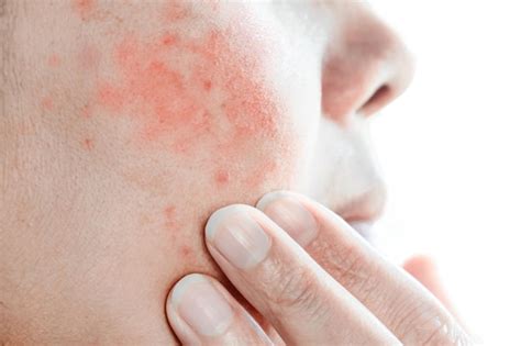 Premium Photo More Red Rashes Appear On Womens Faces Due To Cosmetic