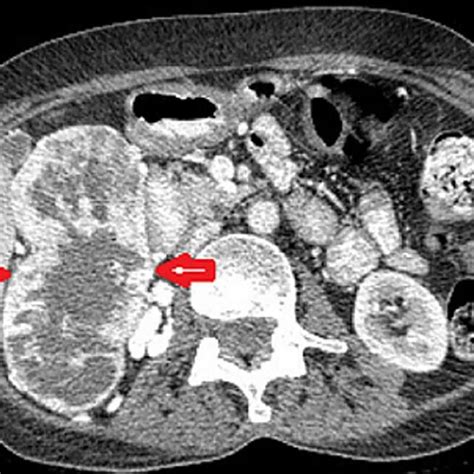 Abdominopelvic Ct Scan With Intravenous Contrast Injection Reveals
