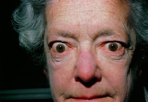 Exophthalmos Bulging Eyes Due To Thyroid Disease Photograph By Dr P