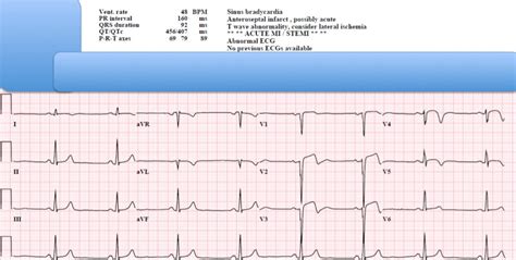 Dr Smiths Ecg Blog Is This Stemi No It Is One Of The Most Common