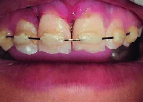 Semi Rigid Splint Placed After Tooth Avulsion Of The Central Incisors