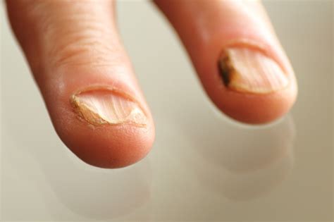 Nail Infection What Causes Fungal Fingernail Infections