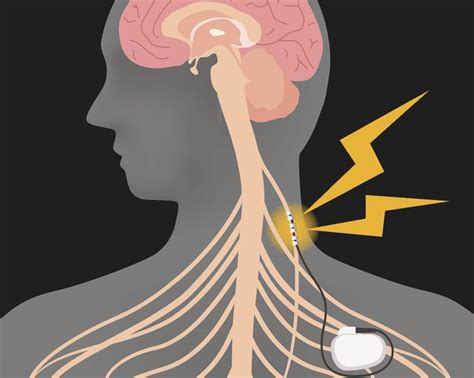 Noninvasive Vagus Nerve Stimulation May Improve Parkinson Disease Symptoms Psychiatry Advisor