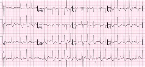 Dr Smiths Ecg Blog What Is The Culprit Artery Not What You Think