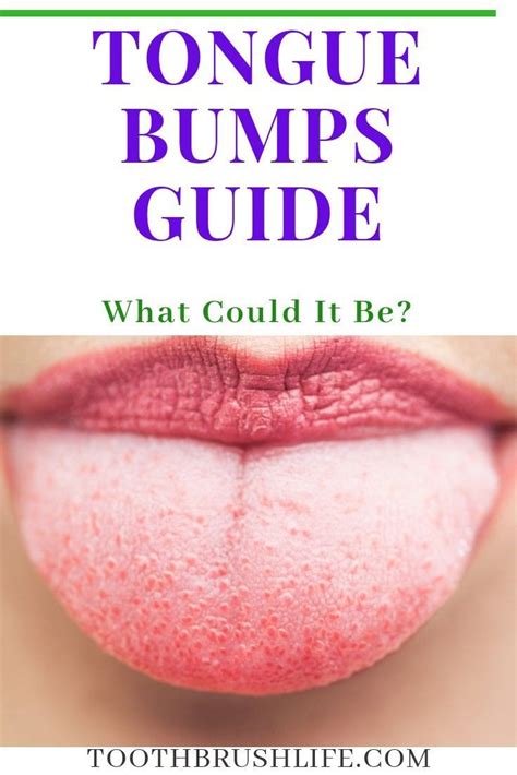 Tongue Bumps Guide Heres What You Need To Know