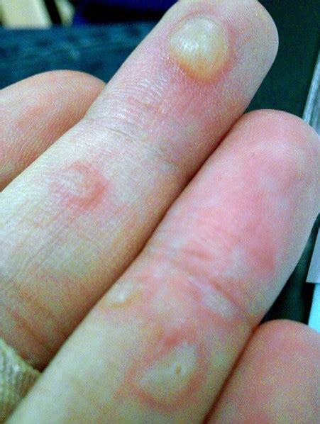 Watery Blisters On Hands Pictures Photos