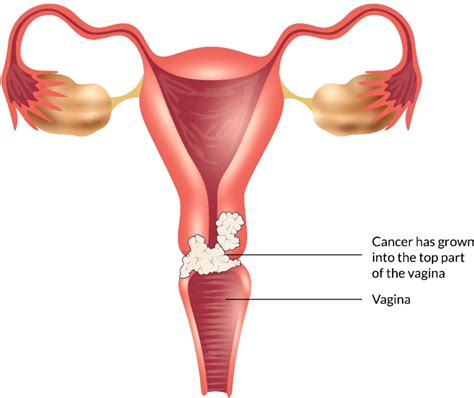 Frontiers A Comprehensive Discussion In Vaginal Cancer Based On