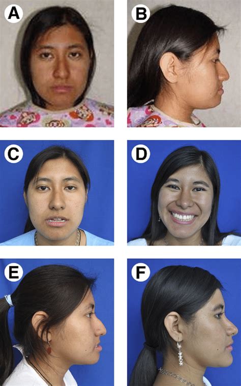 Mid Facial Deficiency Associated With Nasal And Chin Deformities A And