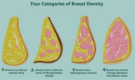 risk factors of breast cancer causes types of breast cancer