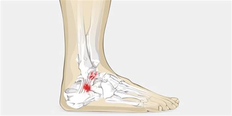 Anterior Ankle Impingement The Complete Injury Guide Vive Health