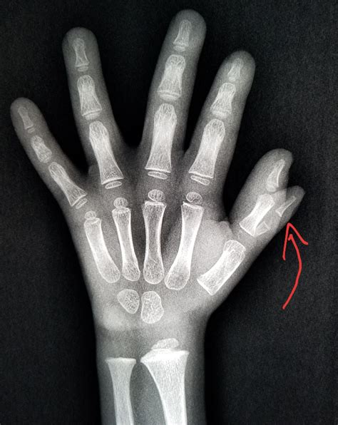 An X Ray Image Of A Hand With Bones Marked In Red
