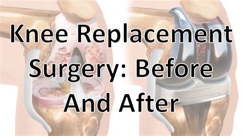 Knee Replacement Surgery Before And After Youtube