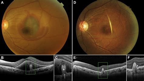 Oct In Choroidal Rupture With Submacular Hemorrhage Ophthalmology Retina