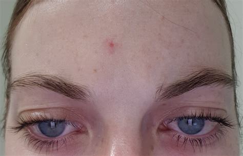 What Is This Red Dot On My Forehead And Who Should I Seewhat Should I