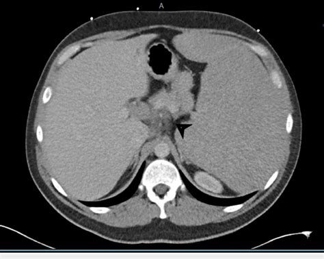 Ct Abdomen And Pelvis With Iv Contrast Demonstrating A 26 X 14 Cm