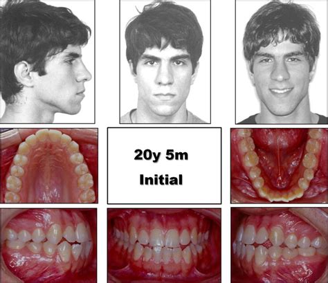Class Iii Malocclusion Treatment Options Fantasies Blook Pictures Gallery