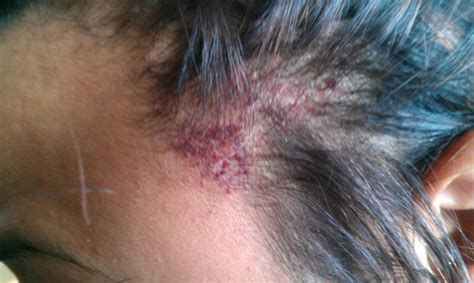 Minor irritation and redness is common, but severe burns deep into the skin have not been commonly reported. Perms and Fibroid Tumors