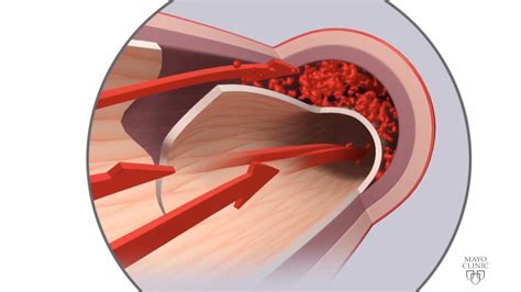 Mayo Clinic Minute What Is Spontaneous Coronary Artery Dissection