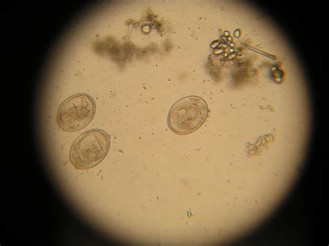An unknown parasite ovum larger than a roundworm ova. Also ...