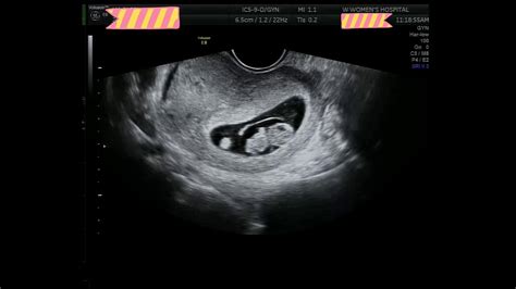 8 Weeks Pregnant Ultrasound With Heartbeat Youtube