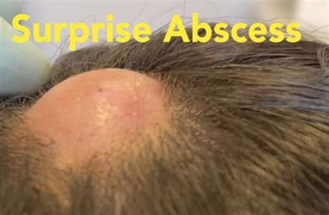 Scalp Surprise Abscess New Pimple Popping Videos
