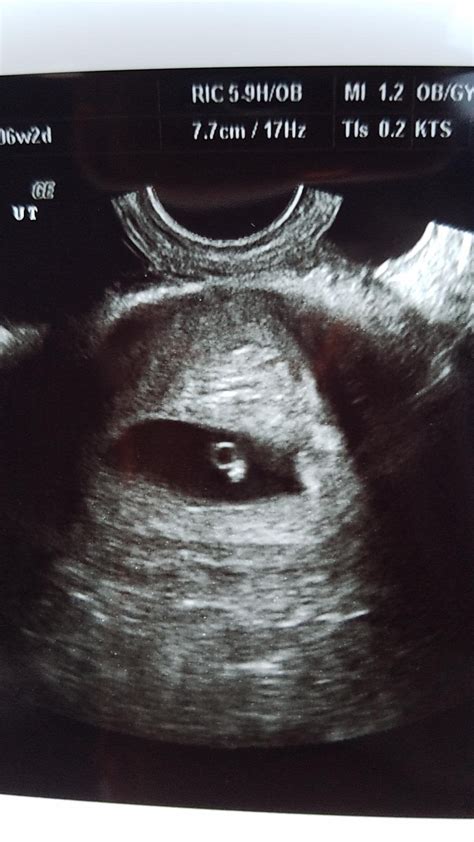 Had My 6 Week Ultrasound Today Heres A Pic For Anyone Who Is