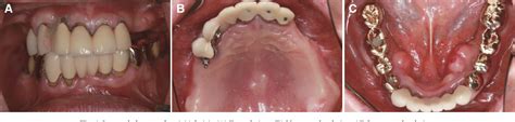 Figure 1 From Full Mouth Rehabilitation With Implant Supported Fixed