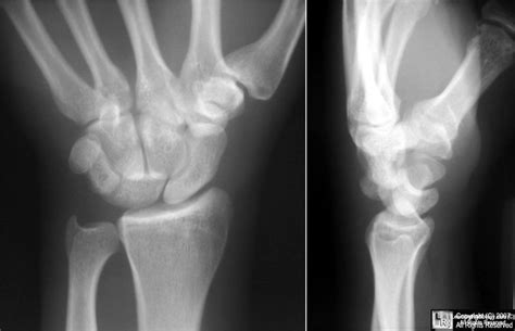 Learningradiology Carpal Instabilities