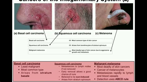 Skin Cancer Types Squamous Cell Carcinoma